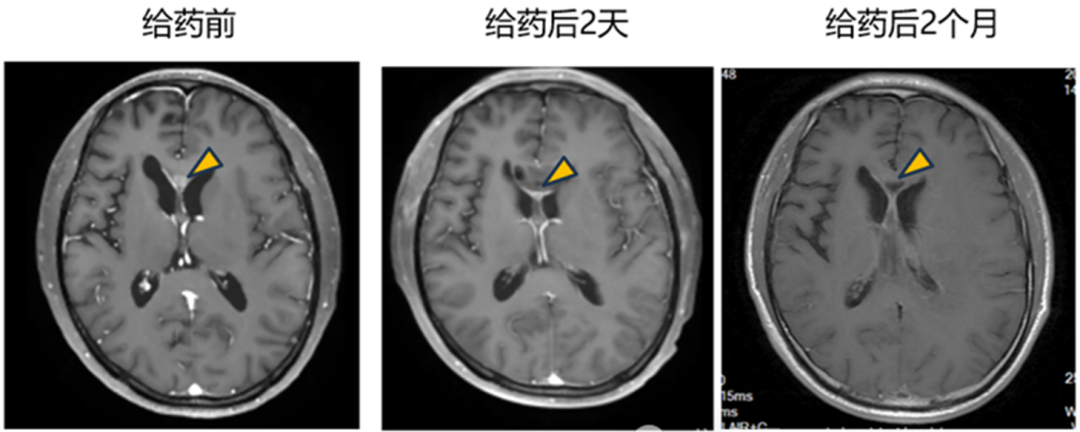 靶病灶显著缩小超过 90%（图1）